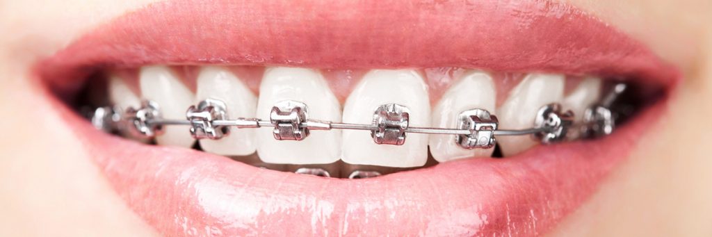 Stock image showing steel braces on upper teeth