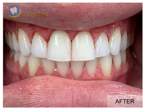 closeup on teeth, cosmetic bonding after