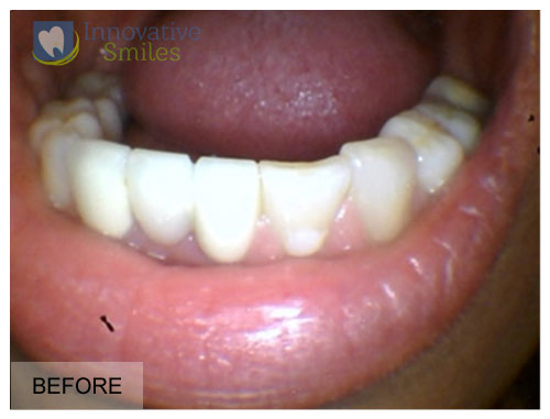 closeup on mouth, lower anterior before anterior fixed bridge