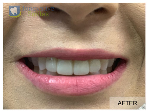 closeup on mouth after veneers