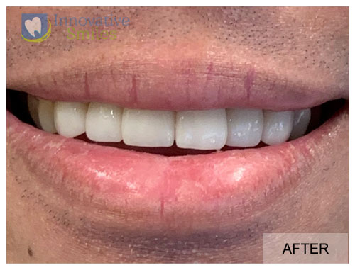 closeup on mouth after veneers