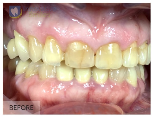 dental patient before receiving veneers closeup on teeth