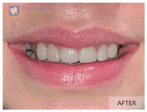 closeup on mouth after upper anterior porcelain veneers