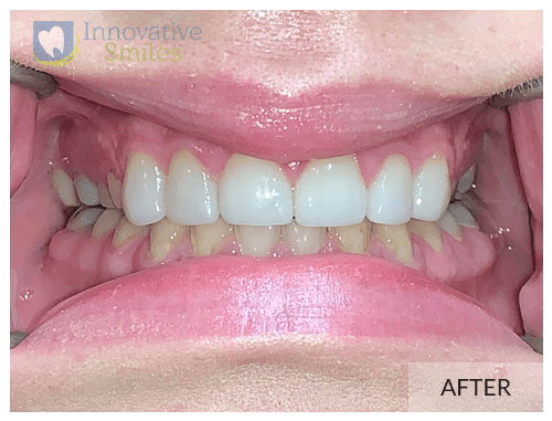 closeup on mouth after upper anterior porcelain veneers