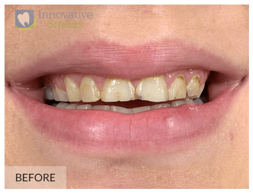 closeup on mouth before upper anterior porcelain veneers